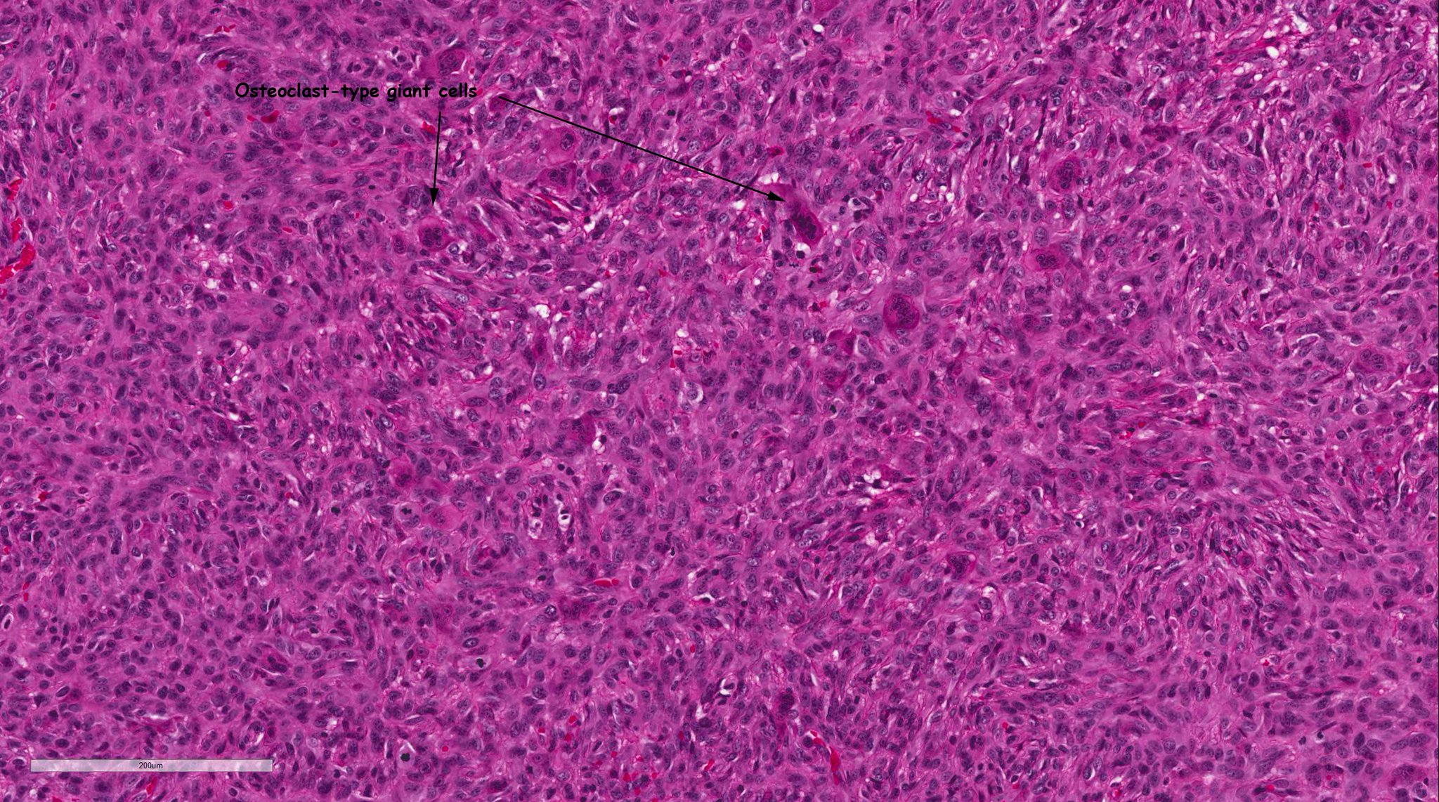 Bin Xu on Twitter "7 Heterologous component may be seen in a small