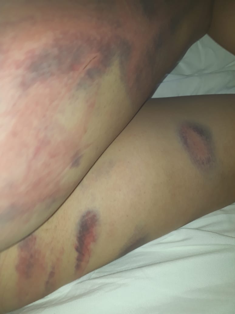 MatiBagnato's tweet photo. Lorena se contactó conmigo recién pidiendo ayuda, así la atacó su ex pareja q vive a 3 cuadras de su casa.
Me pidió hacer público su caso y estas fotos porque tiene terror q la mate.
Ojala pronto detengan a esta bestia y Lorena pueda vivir en paz. https://t.co/KMcEAvuvv1