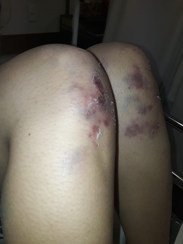 MatiBagnato's tweet photo. Lorena se contactó conmigo recién pidiendo ayuda, así la atacó su ex pareja q vive a 3 cuadras de su casa.
Me pidió hacer público su caso y estas fotos porque tiene terror q la mate.
Ojala pronto detengan a esta bestia y Lorena pueda vivir en paz. https://t.co/KMcEAvuvv1