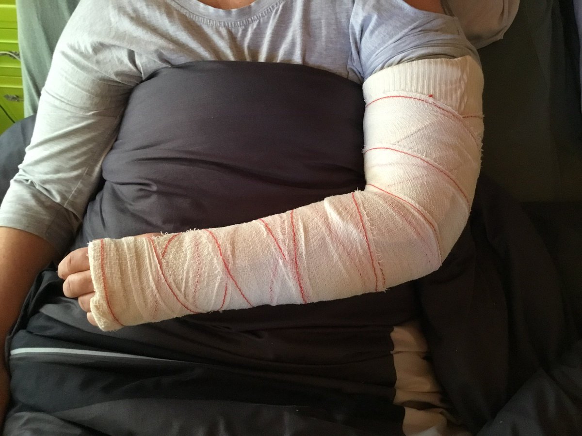 donnaeffie's tweet photo. Goeiemorgen allemaal , zal nog een tijdje niet veel op twiiter zijn , nu zes weken met linker arm in gips 🤨. Dikke knuff allemaal denk aan jullie 😘💋👋🏽 https://t.co/SCgY2ceSyH