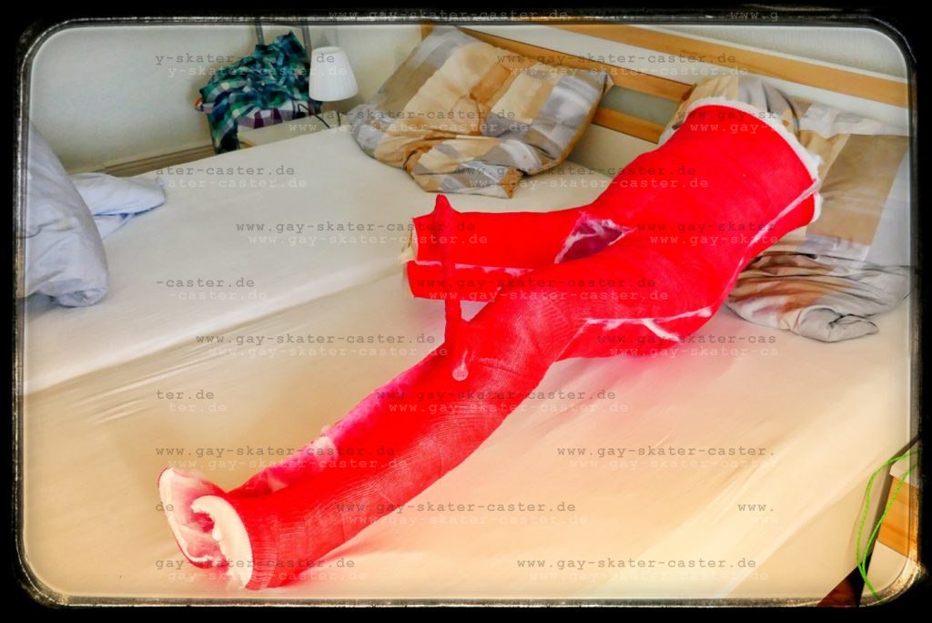 GaySkaterCaster's tweet photo. 2018-10 hs
Sneak preview of my 1,5 #hs during our #castfest with 3 caster!
Day 6: woke up this morning and had this sad view. Good bye #hipspica. No #hipcast anymore. Was a great time in this big fast #fibercast
https://t.co/6nHgWNHiIh https://t.co/U50Vc9LIey