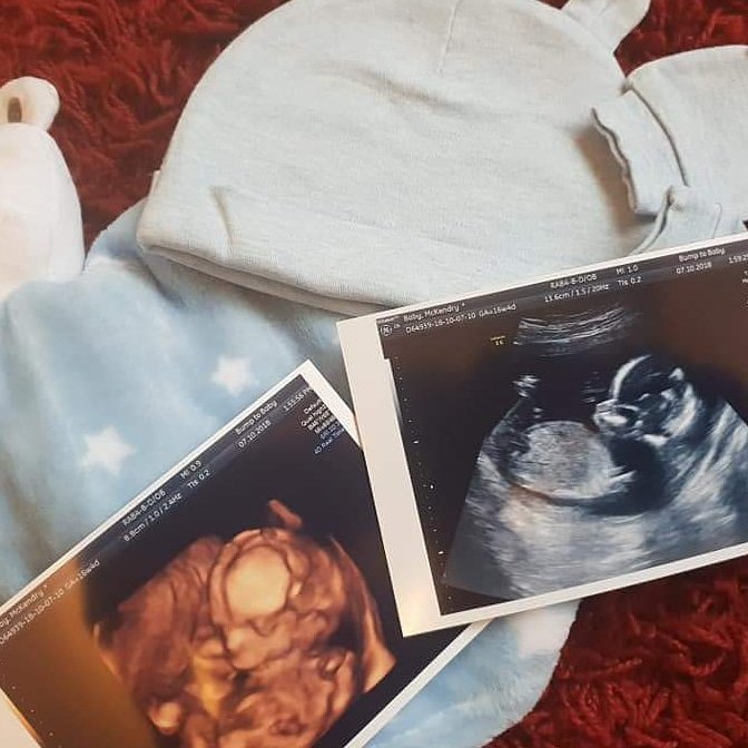 amymurray1690's tweet photo. Our gorgeous boy. We can't wait to meet you little man @CraigGPBFB 💙💙💙 https://t.co/o5vQHkV6Dy