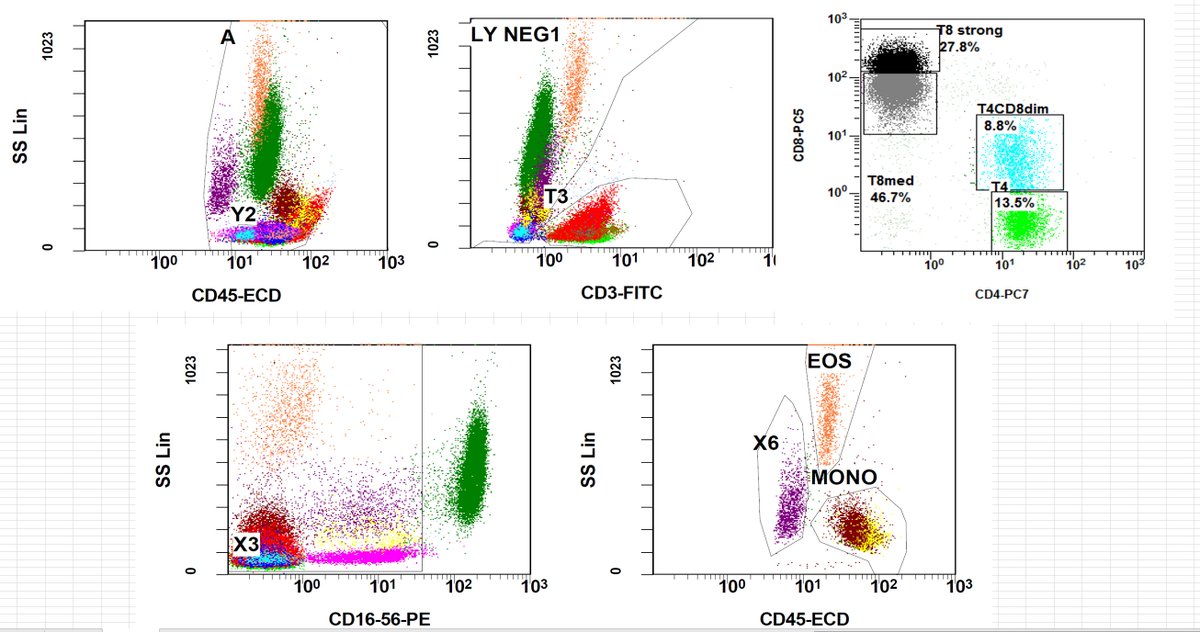 QUIZ(NEW) 18F with quinsy, fever and jaundice. Palpable cervical lymphadenopathy Anemia, leukocytosis and transaminasemia. Please vote in next tweets #hemepath, #morphology #flowcytometry