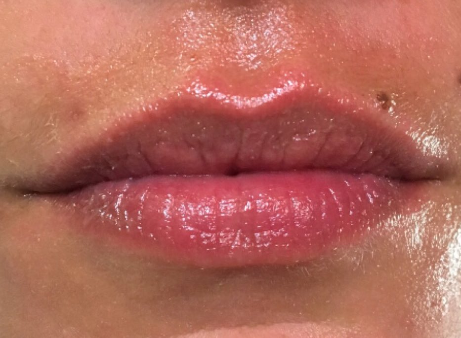 daniscrilda's tweet image. Boca linda, preenchida e contornada!
#neoclinicfloripa #preenchimentolabial #acidohialuronico