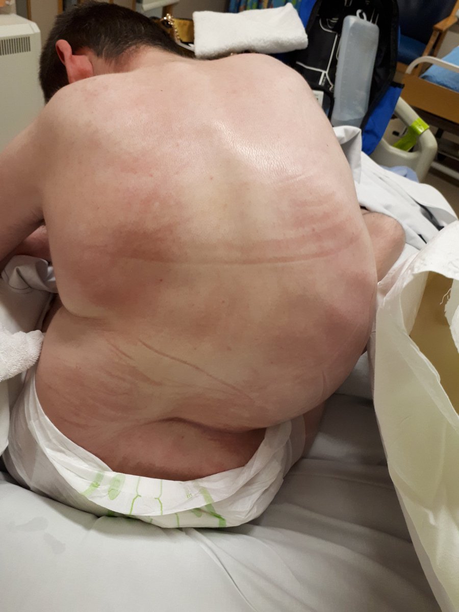 Tracy 💜 ☮️📸 ✍🏼🏠 (@addressinglife) on Twitter photo #scoliosis I took this tonight. It'll be the last photo of Brendan's back before his spinal fusion tomorrow. <a href="/SimonHarrisTD/">Simon Harris TD</a> this is what happens making a child wait over 16 months on the so called URGENT operation list. Look at him, please. This is the result of failed policy. #scoliosis I took this tonight. It'll be the last photo of Brendan's back before his spinal fusion tomorrow. <a href="/SimonHarrisTD/">Simon Harris TD</a> this is what happens making a child wait over 16 months on the so called URGENT operation list. Look at him, please. This is the result of failed policy.