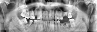 wisdomteeth_dr's tweet photo. If it is a simple #extraction of just one tooth – the cost may begin from $75 and may go up to $200 depending on the #teeth and the #impact. A guide to the #costoftoothextraction.. https://t.co/SD7iqNA03G https://t.co/Dgr4yP7Lkg
