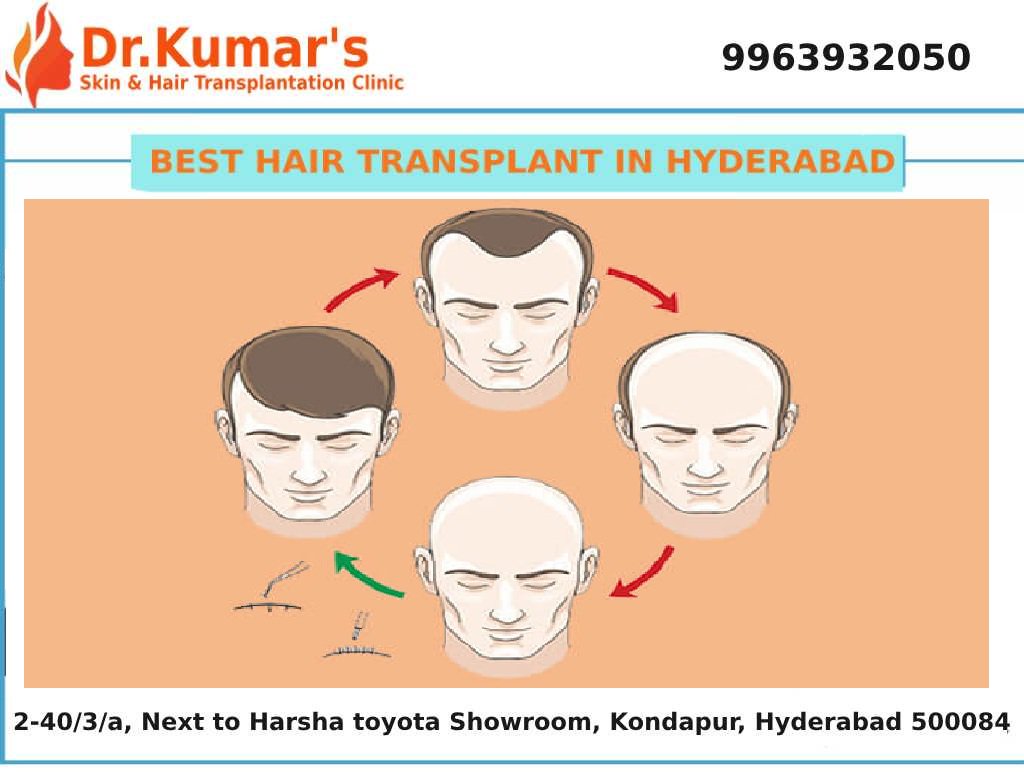 drashokkumar143's tweet image. Hair Transplant in Hyderabad
thehaircare.co.in
Best Hair Care Clinic in Hyderabad. 100% Results, No Pain.
#Hair_Transplants
#Hair_Transplant_in_Hyderabad
#Hair_Transplantation_in_Hyderabad