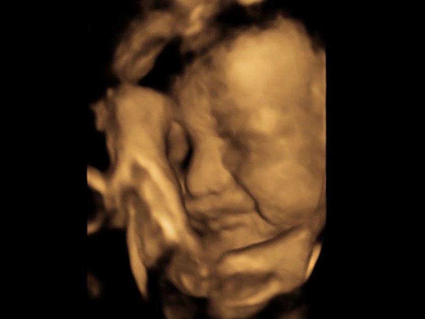 windowtothewomb's tweet photo. This Little One Wasn't a Happy Bunny! π #4dscan #4dbabyscan #4dultrasound #meetmybaby #babyface #ultrasound #genderscan #wellbeingscan https://t.co/EIoCoYitHw