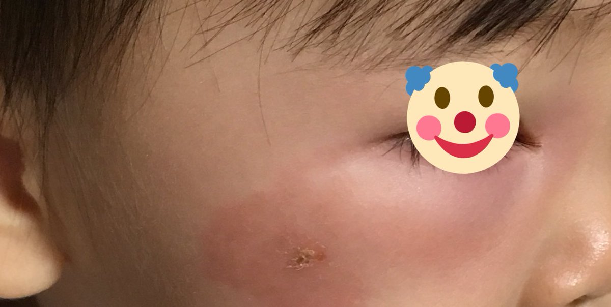 Simo V Twitter ヤブ蚊なのか何の虫だかわからないけど 公園で刺されたっぽくて広い範囲に腫れて来た 目が押し潰されて顔が全然違う アナフィラキシーショックかと思って焦った 病院行ったけど虫刺されだねで終わって塗り薬と飲み薬貰って来たけど 早く治ると