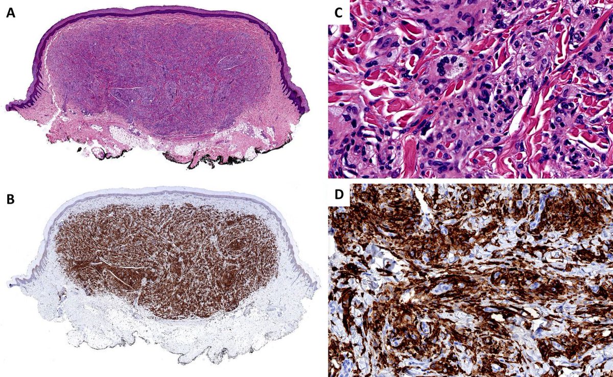 JClinPath_BMJ's tweet photo. Histologically, tuberous #xanthomas may simulate fibrohistiocytic lesions and particularly lipidised histiocytoma present in the lower limb, especially the ankle type, although the latter usually shows extensive hyalinisation, writes Martin et al
https://t.co/GJab3vqEkR https://t.co/8IUrP6Wn7G