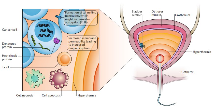 drtanws's tweet photo. Our newest article comprehensively reviewing the literature on #device assisted therapies & #hyperthermia for #bladdercancer in @NatRevUrol @Jkurol @Synergo_RITE @CombatCancer @PhysionEmda #tarisbiomedical #urogen https://t.co/JofgBenY7x https://t.co/de2QWYOy0j