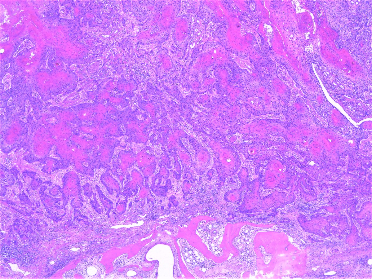 Patholwalker's tweet image. Squamous cell carcinoma, well differentiated type. External ear canal, resection. #pathology #ENTpath