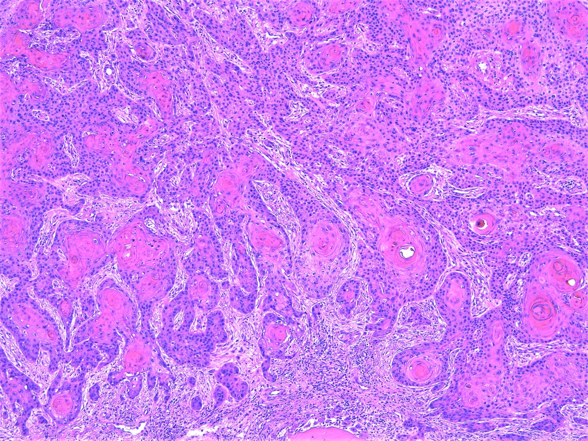 Patholwalker's tweet image. Squamous cell carcinoma, well differentiated type. External ear canal, resection. #pathology #ENTpath