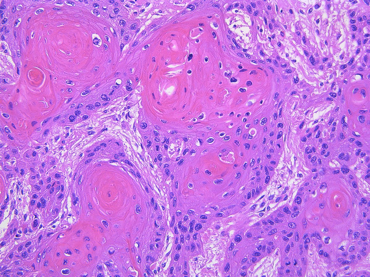 Patholwalker's tweet image. Squamous cell carcinoma, well differentiated type. External ear canal, resection. #pathology #ENTpath