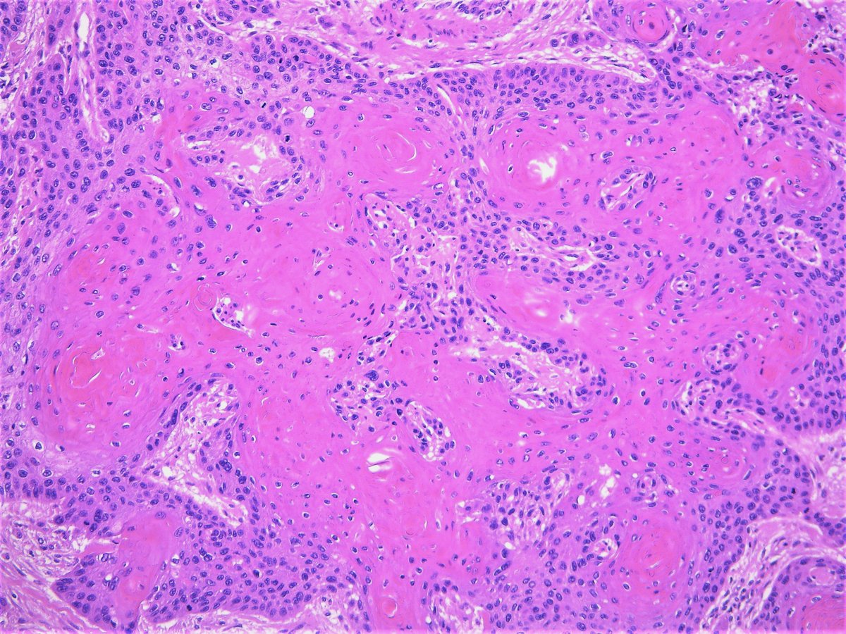 Patholwalker's tweet image. Squamous cell carcinoma, well differentiated type. External ear canal, resection. #pathology #ENTpath
