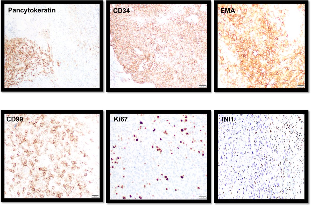TexPathol's tweet photo. Also - for S100, Desmin, p63, CD31 and ERG. Vimentin +
Diagnosis: Epithelioid Sarcoma.
Epithelioid sarcoma: First described in 1972, Proximal Type more aggressive. May metastasize to lymph nodes. Loss of INI1 expression is characteristic. #BSTpath #TSPchallenge @JaitlyVanya https://t.co/clE4eSWeUS