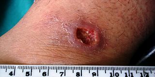 Infectdispract's tweet photo. #Leishmaniasis: This disease is caused by the bite of the sandfly. A #parasitic_infection which causes skin ulcers and may also infect the internal organs laeding to fatal consequences. 
https://t.co/PDVdPLqkz2 https://t.co/qgFKgHa4Ky