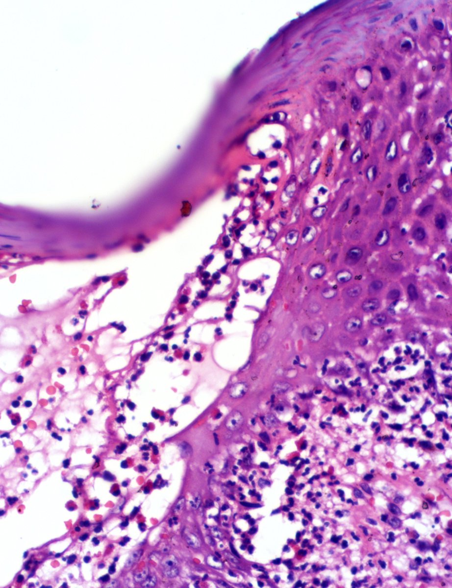 DrGeeONE's tweet photo. For your opinions
Blisters (with wide distribution) in a 4 year old female of 14 months duration. Intensely pruritic and leaves hyperpigmented scars. Unfortunately no facility for IF studies.
My impression: DH vs linear IgA bullous dermatosis
#dermpath #dermatology #PathThread https://t.co/v3VkiHhJDc