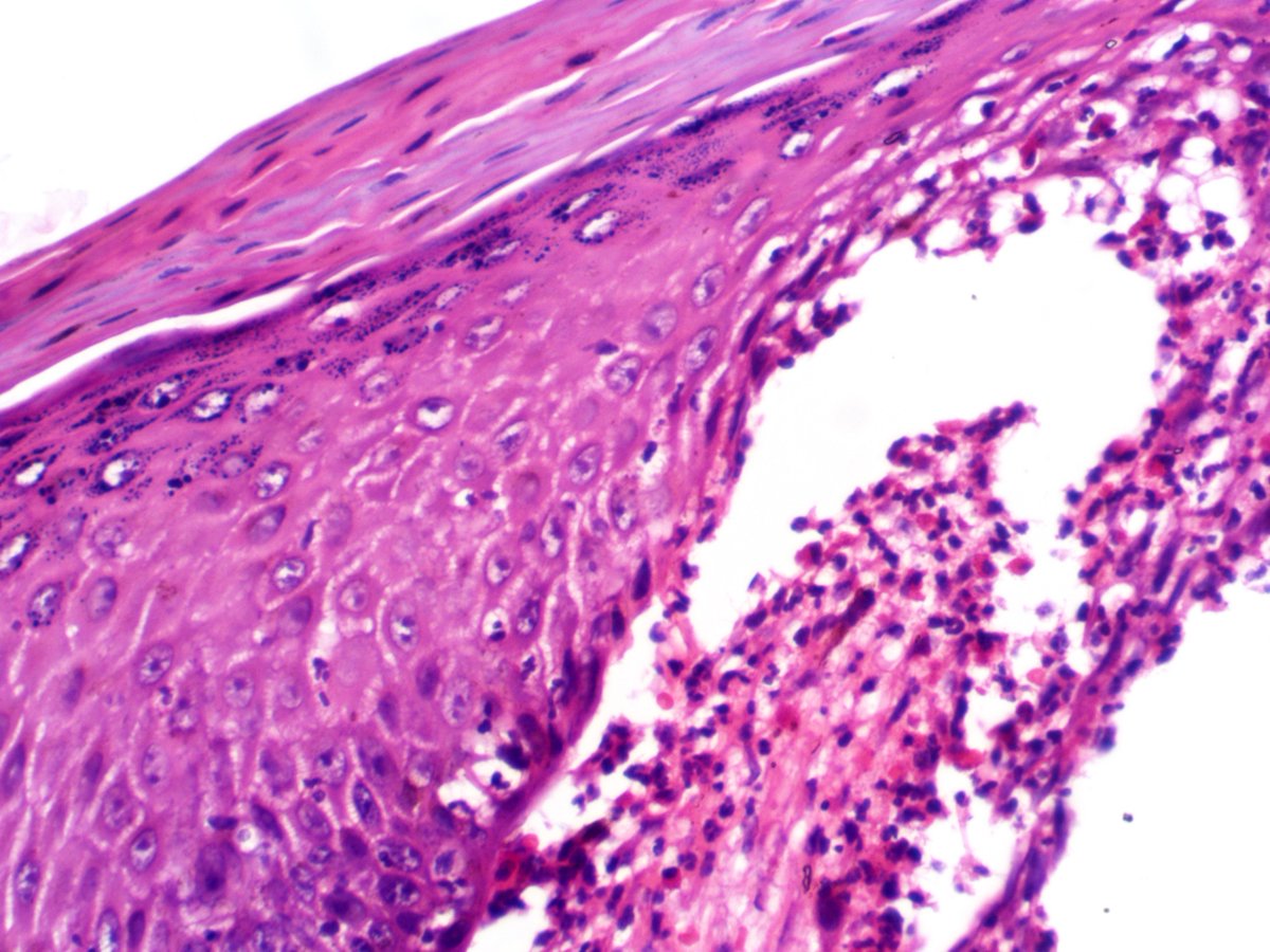 DrGeeONE's tweet photo. For your opinions
Blisters (with wide distribution) in a 4 year old female of 14 months duration. Intensely pruritic and leaves hyperpigmented scars. Unfortunately no facility for IF studies.
My impression: DH vs linear IgA bullous dermatosis
#dermpath #dermatology #PathThread https://t.co/v3VkiHhJDc