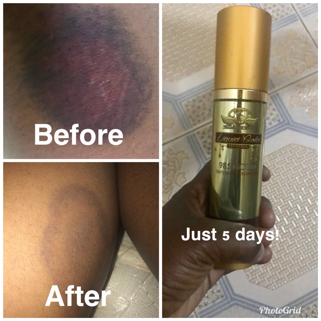 Had this ‘ecchymosis’ and I didn’t want it to stop me from wearing my mini skirts... in just 5 days.... my scar has improved and it’s almost faded! Liquid Gold is the deal! 😍😍😍😍...dm me for yours