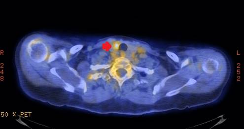 TheAAES's tweet photo. Examination with ultrasound can stratify risk of malignancy risk for thyroid incidentalomas detected on 18F-FDG PET/CT. https://t.co/W7Hb4Qxa94 #CheckYourThyroid #THYCAM2018 @ThyCaInc @AmCollSurgeons @AmThyroidAssn @TheAACE @TheEndoSociety https://t.co/6WxlUfQwxc