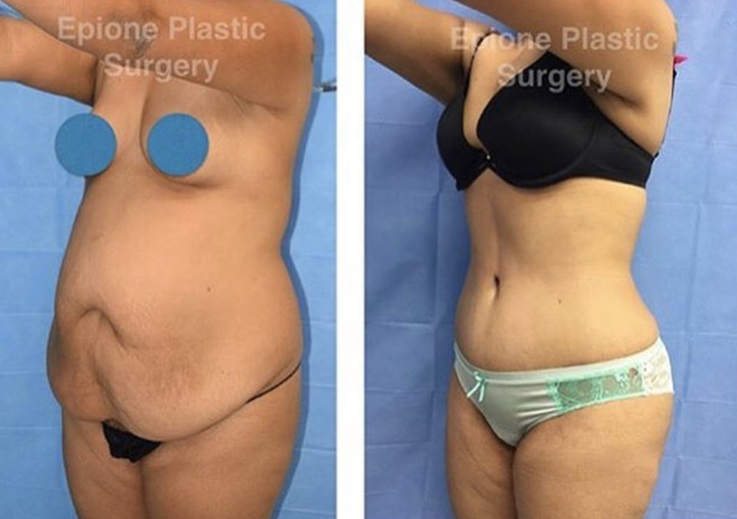 tummy tuck recovery tummy tuck recovery
