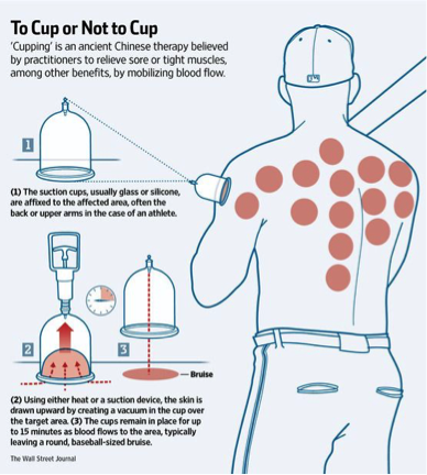 CunicoHealth's tweet photo. Tight muscles, poor blood flow, and chronic pain doesn’t need to be apart of your daily routine. Cupping is a method using suction on problem areas to loosen muscles and relieve pain. Share this with your friends who might be suffering from tight muscles. #RelieveYourPain https://t.co/F2n1w2VTEt
