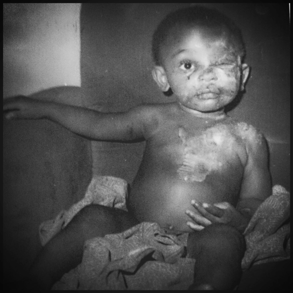 KaarisOfficiel1's tweet photo. Tête brûlée depuis la naissance 
Ils avaient dit que j’allais perdre mon oeil et garder des séquelles regardez ou j’en suis aujourd’hui il ne faut jamais baisser les bras face aux épreuves #allahkabô🙏🏿
Vendredi premier extrait de ORNOIR3 « ABORIGÈNE » https://t.co/nM8uHZTVc0