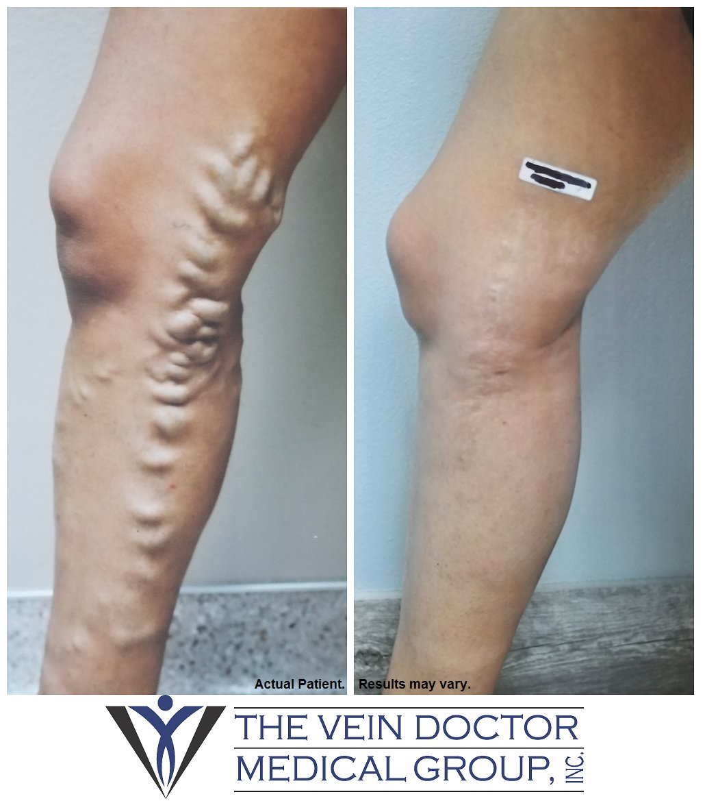 TheVeinDoctor's tweet photo. #Diseased veins that are left untreated may lead to:
#BloodClots, #Ulcers, #Swelling &amp; #Inflammation, and/or Unsightly, #BulgingVeins. To prevent these occurrences, schedule your #vein screening today by calling 760-340-2200.
#theveindoctormedicalgroup #drg #veins #varicoseveins https://t.co/IEs6Wn2jD7