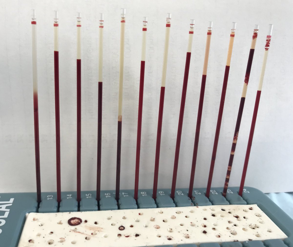 DanielRicottaMD's tweet photo. How does anemia, polycythemia, lipids, bilirubin and varying levels of fibrinogen impact ESR? Let’s find out #MDIPOF18 https://t.co/Qqn2ZiKSlQ