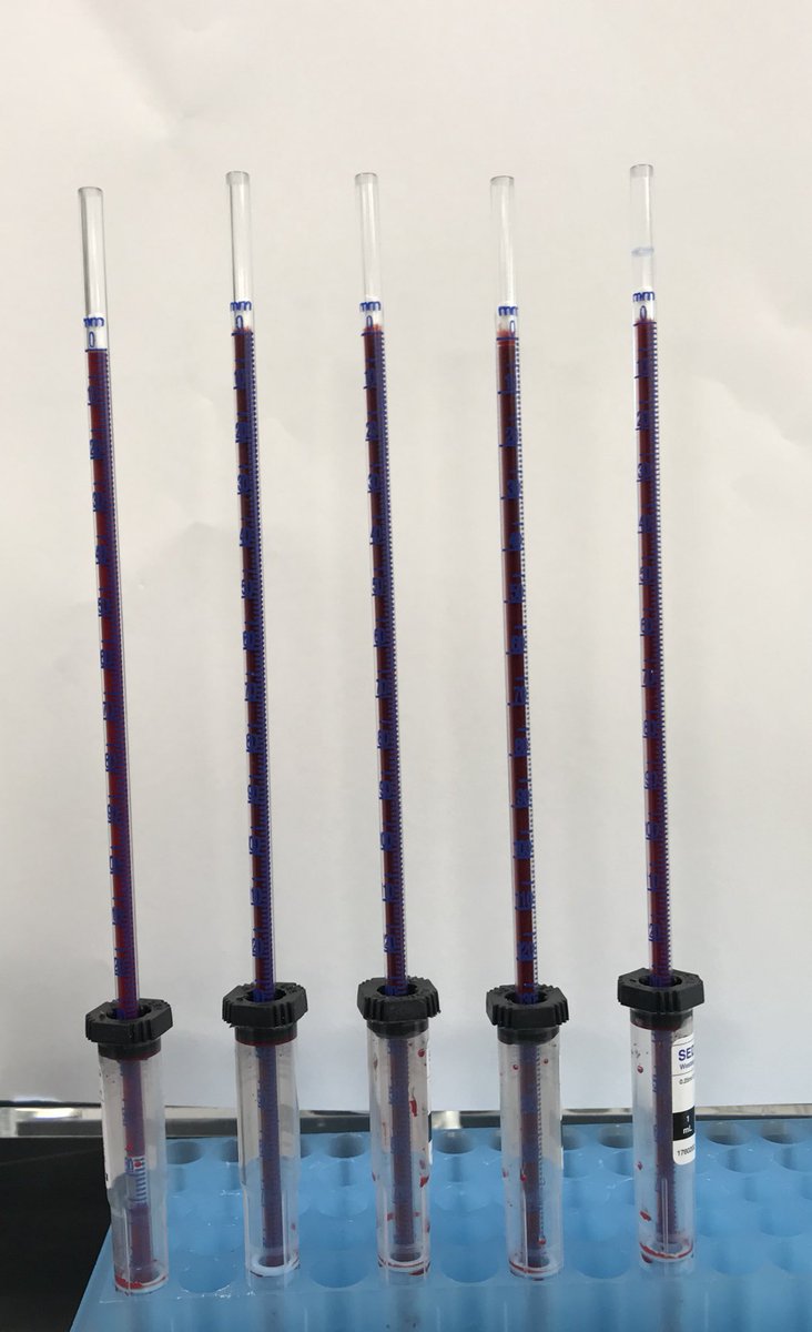 DanielRicottaMD's tweet photo. Ever wonder why ESR can be so variable? The key may be fibrinogen! Same blood sample - escalating doses of fibrinogen #physiology #meded #MDIPOF18 @FreedoBaggins @AndyHale33 https://t.co/dwvwA4CFLR