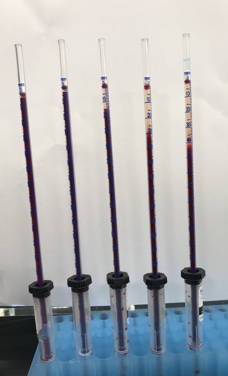 DanielRicottaMD's tweet photo. Ever wonder why ESR can be so variable? The key may be fibrinogen! Same blood sample - escalating doses of fibrinogen #physiology #meded #MDIPOF18 @FreedoBaggins @AndyHale33 https://t.co/dwvwA4CFLR