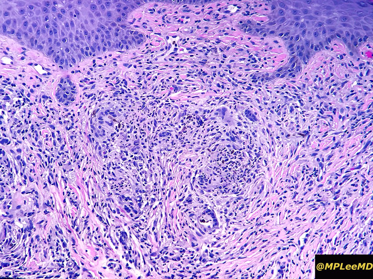 Phaeohyphomycosis. This is an infection caused by dermatiaceous - darkly melanin pigmented - fungi. These organisms are naturally found in soil and wood. Local trauma is usually the method of infection. #dermatology #dermpath #fungi @JMGardnerMD @MightyDermPath  @NRiddleMD