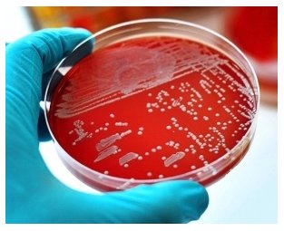 DukeMedSchool's tweet photo. New Way of Determining Treatment for Staph Infections Cuts Antibiotic Use. Thomas L. Holland, MD, lead author of study in JAMA. Using clinical checklist doctors able to shorten antibiotic duration for uncomplicated infections by nearly two days. https://t.co/9dMVgEQGCH https://t.co/XRLBfVnm35