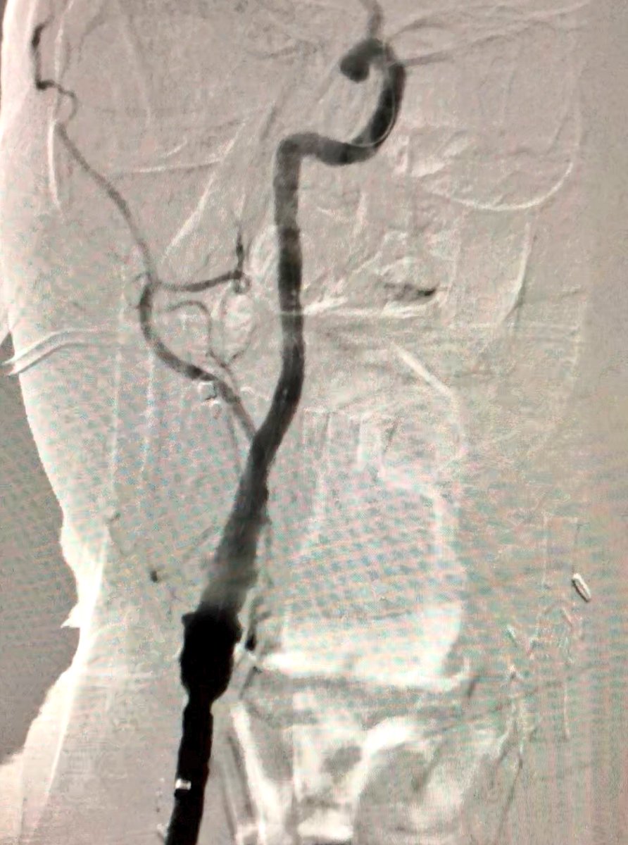matheenkhuddus's tweet image. 56 y/o WM with symptomatic R CCA/ICA disease, previous CEA. Carotid artery stenting planned via #RadialFirst approach but converted to ulnar based on vessel size by ultrasound #SCAIPAD