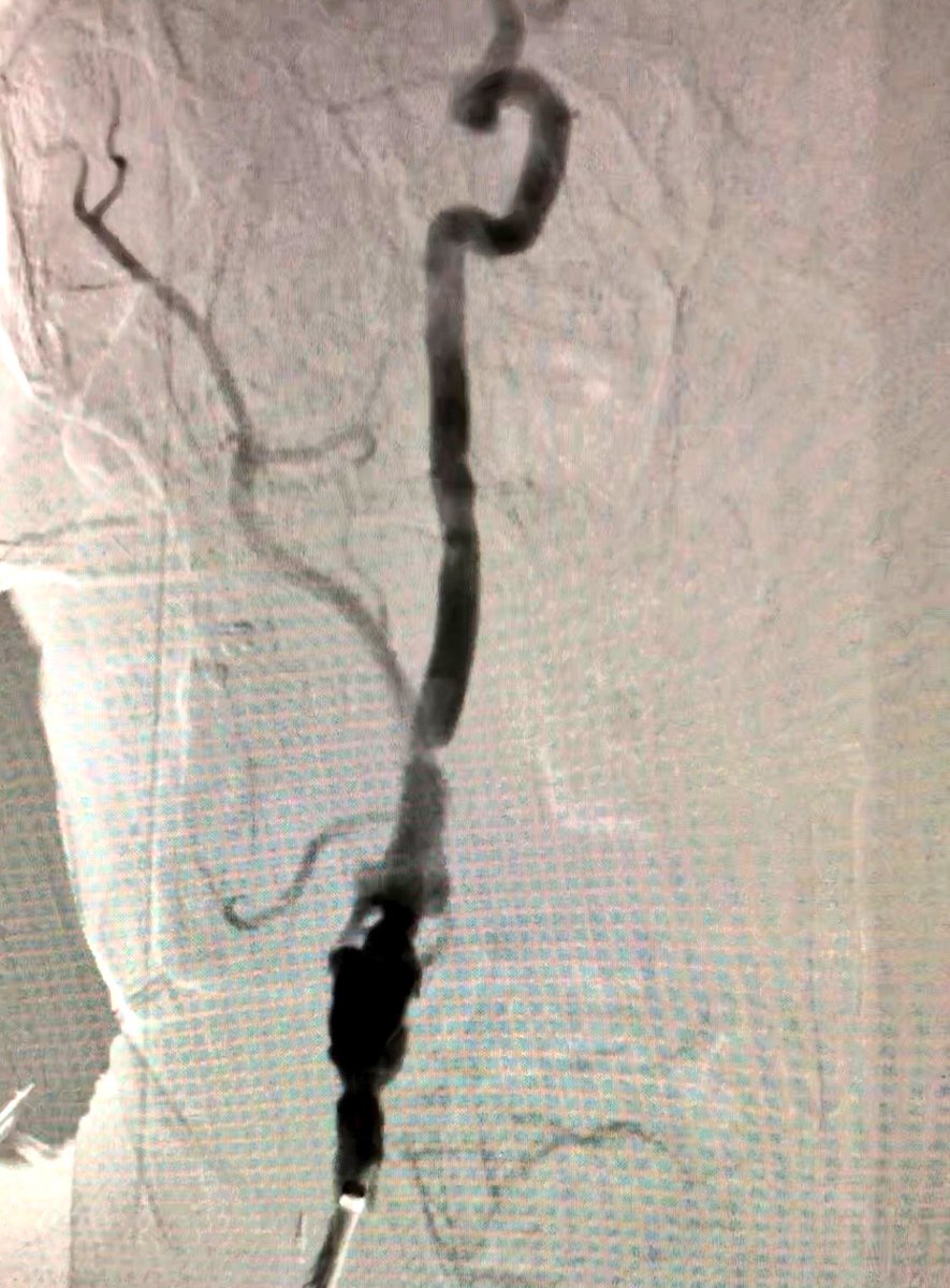 matheenkhuddus's tweet image. 56 y/o WM with symptomatic R CCA/ICA disease, previous CEA. Carotid artery stenting planned via #RadialFirst approach but converted to ulnar based on vessel size by ultrasound #SCAIPAD
