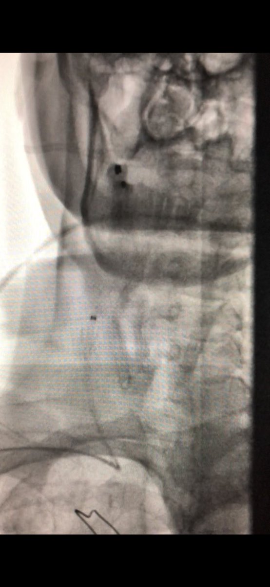 matheenkhuddus's tweet image. 56 y/o WM with symptomatic R CCA/ICA disease, previous CEA. Carotid artery stenting planned via #RadialFirst approach but converted to ulnar based on vessel size by ultrasound #SCAIPAD