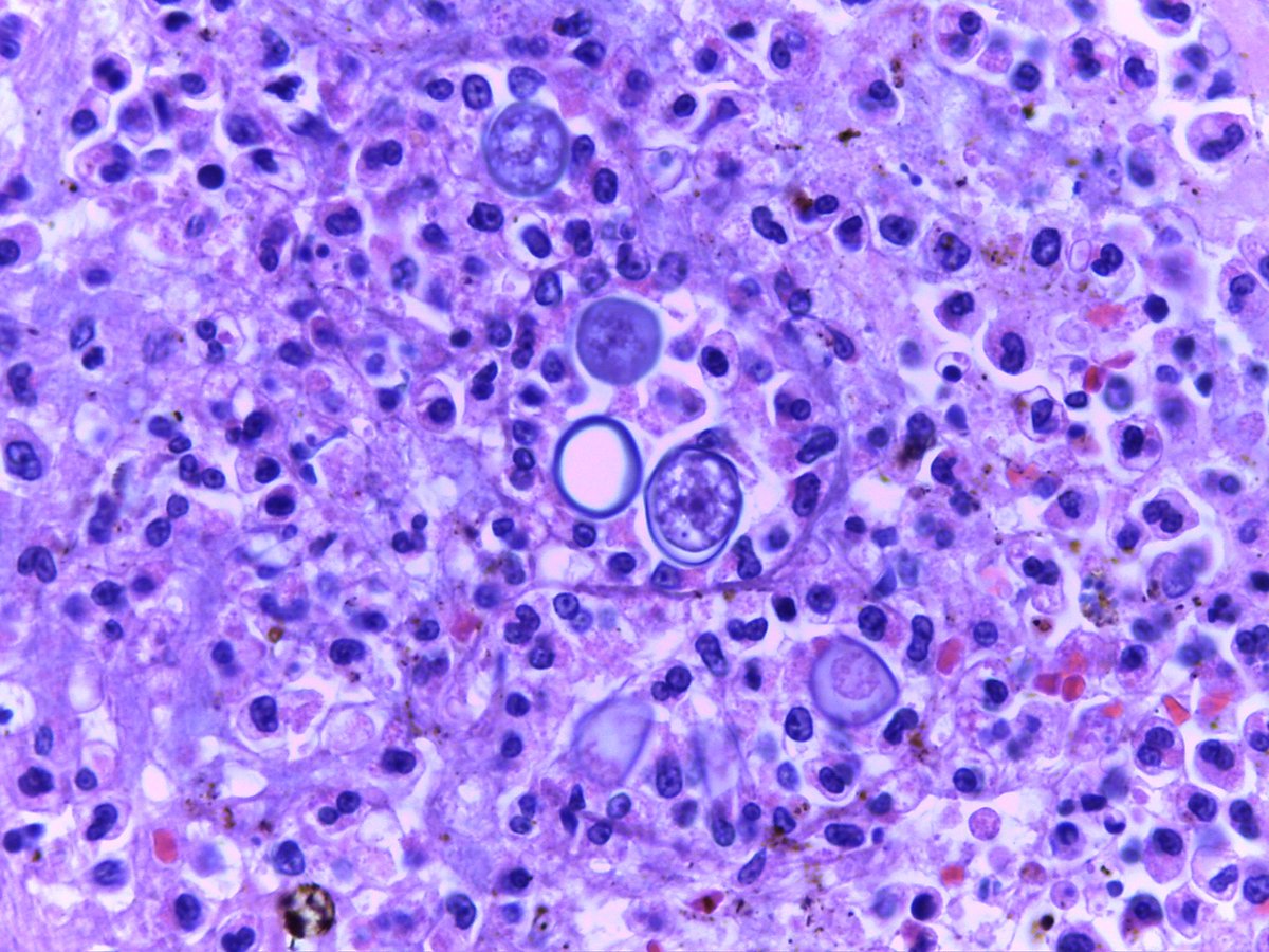 AtikankulTaywin's tweet photo. I found these fungal-like structures in stomach of male 45 Y with clinical dilated stomach and transmural necrosis. Blastomycosis? 🤔 But I cannot find this in literature 😣 What is your opinion? #pathology #surgpath #GIpath #pathbug #pathboards https://t.co/EyynHkHMIa