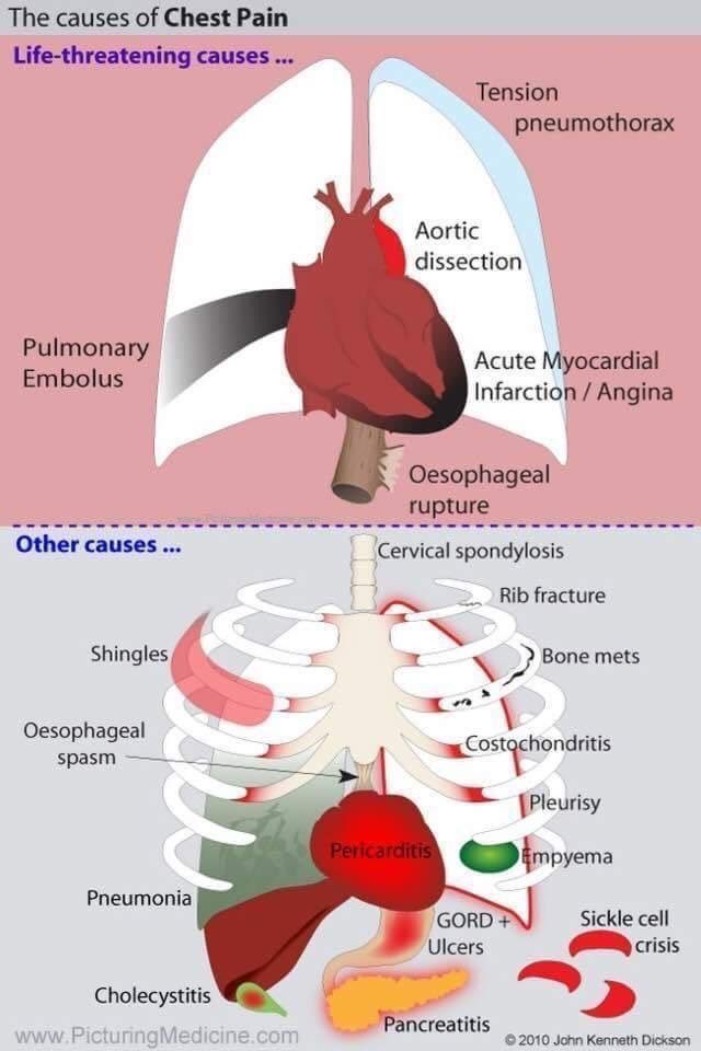 HadoshAlYousef's tweet photo. #medical_tips Chest pain causes . https://t.co/r24pUGiMQi