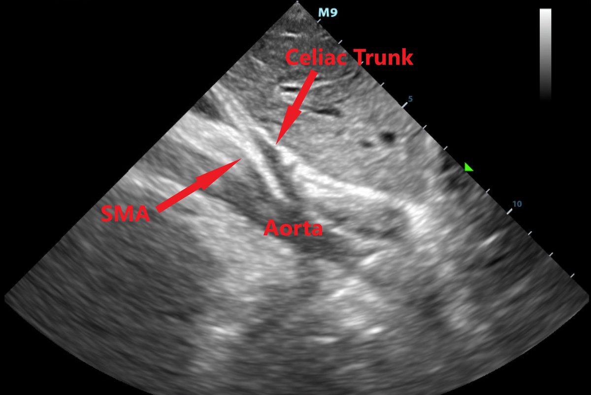 SonoMojo's tweet photo. #SonoProTip: IVC or aorta? Use these tips to help recognize the IVC:
1) Enters right atrium
2) Hepatic veins drain into it
3) Associated w/ caudate lobe of liver
4) Thinner walls
#FOAMus #FOAMed https://t.co/Tn89MlrLkW