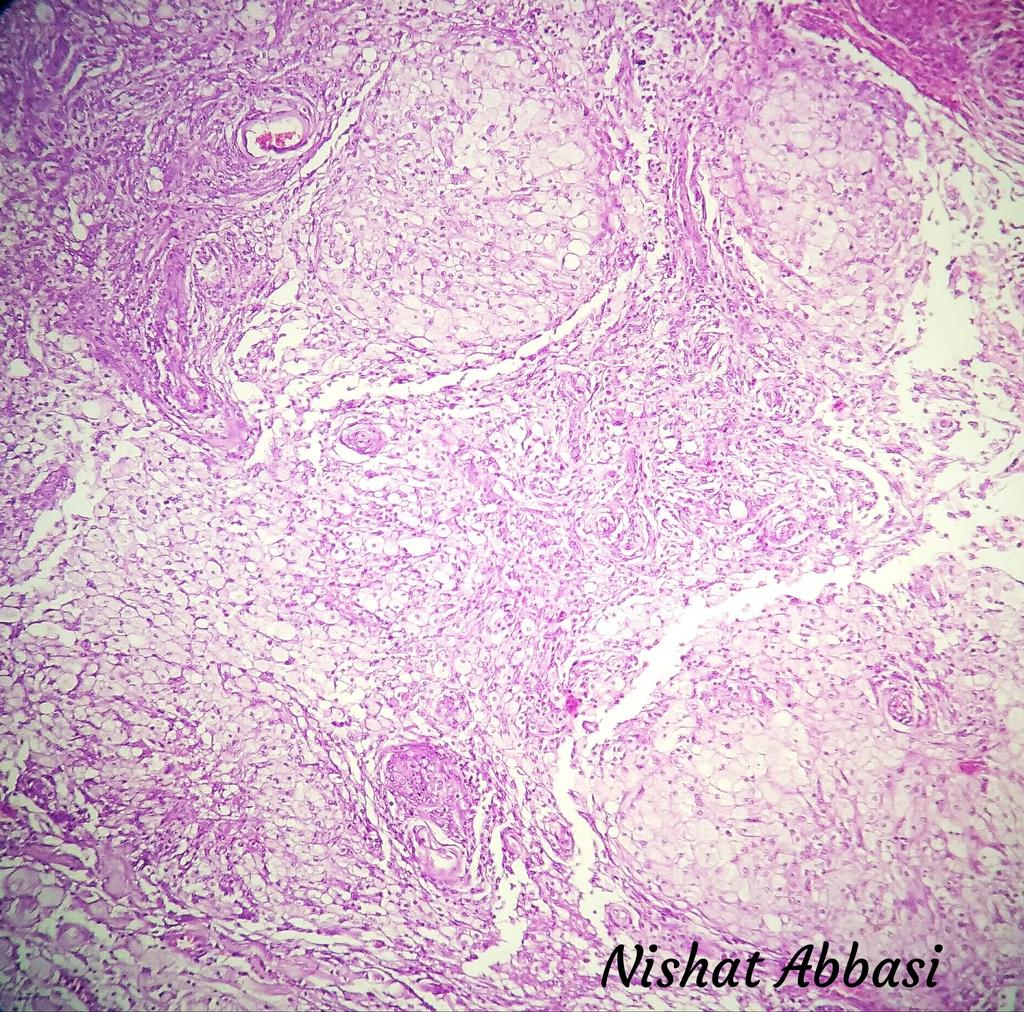 DrNishatAfroz2's tweet photo. A rare variant of Meningioma WHO Grade1:Metaplastic/ Xanthomatous meningioma.IHC is for EMA(shown here),crucial for dx; differentiates from d macrophages.other+ IHC can be Vimentin, PR and sometimesCD68+.#Neuropath #Histopathology #DiagnosticPathology #HumanPathology #pathology https://t.co/23CXEPZg0H