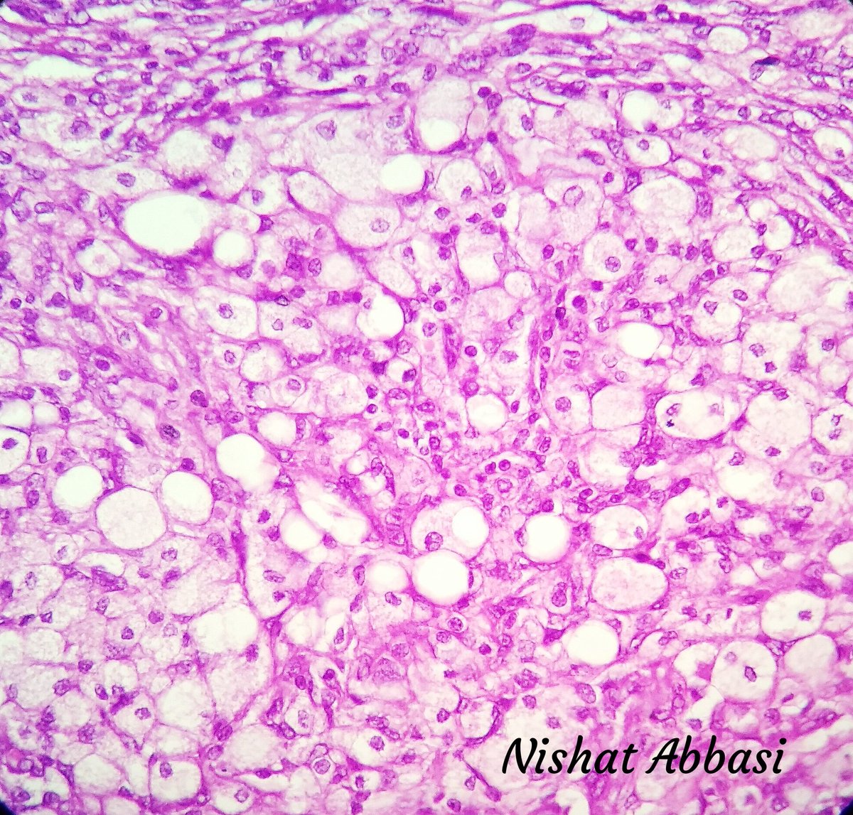 DrNishatAfroz2's tweet photo. A rare variant of Meningioma WHO Grade1:Metaplastic/ Xanthomatous meningioma.IHC is for EMA(shown here),crucial for dx; differentiates from d macrophages.other+ IHC can be Vimentin, PR and sometimesCD68+.#Neuropath #Histopathology #DiagnosticPathology #HumanPathology #pathology https://t.co/23CXEPZg0H