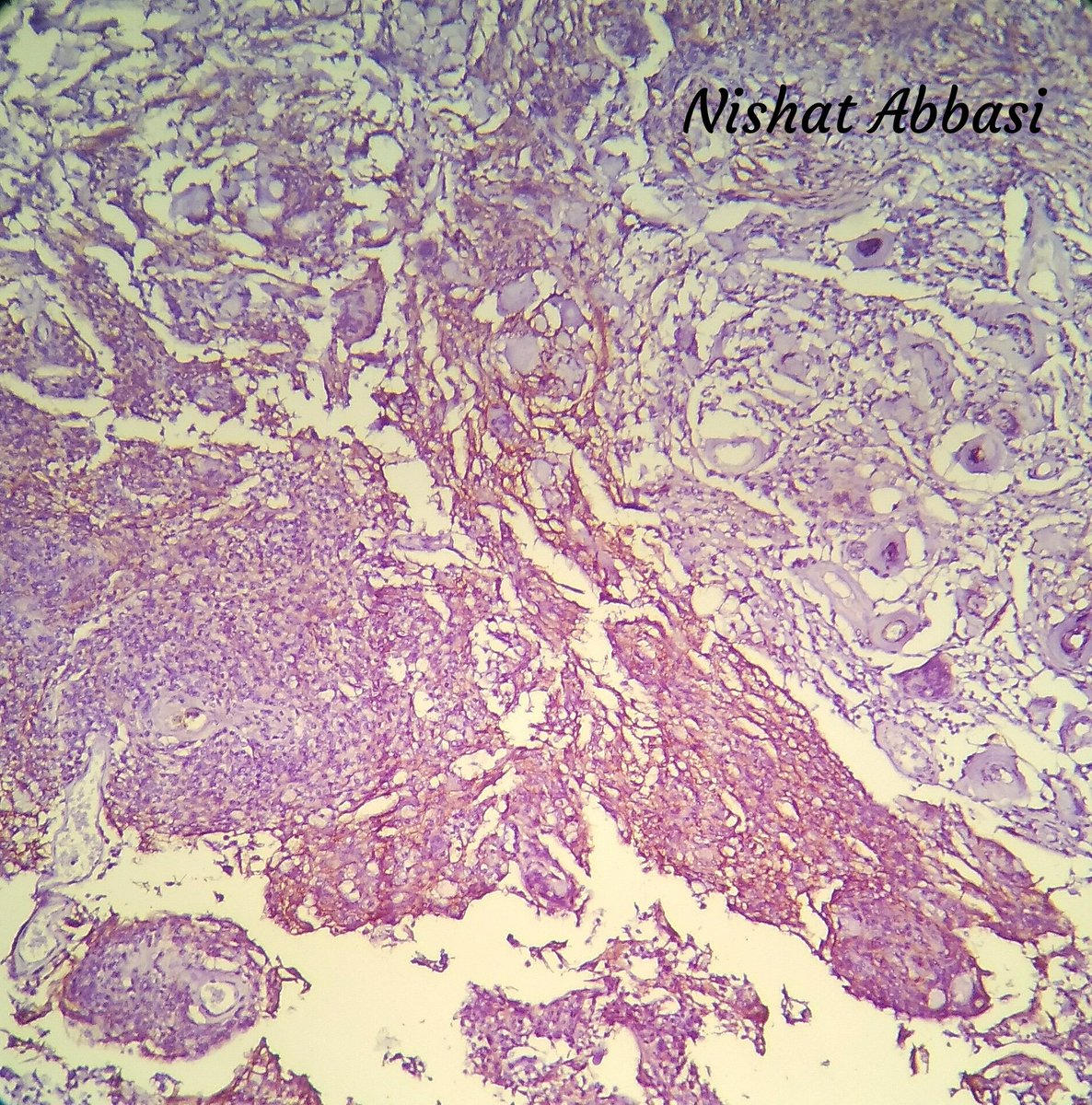 DrNishatAfroz2's tweet photo. A rare variant of Meningioma WHO Grade1:Metaplastic/ Xanthomatous meningioma.IHC is for EMA(shown here),crucial for dx; differentiates from d macrophages.other+ IHC can be Vimentin, PR and sometimesCD68+.#Neuropath #Histopathology #DiagnosticPathology #HumanPathology #pathology https://t.co/23CXEPZg0H