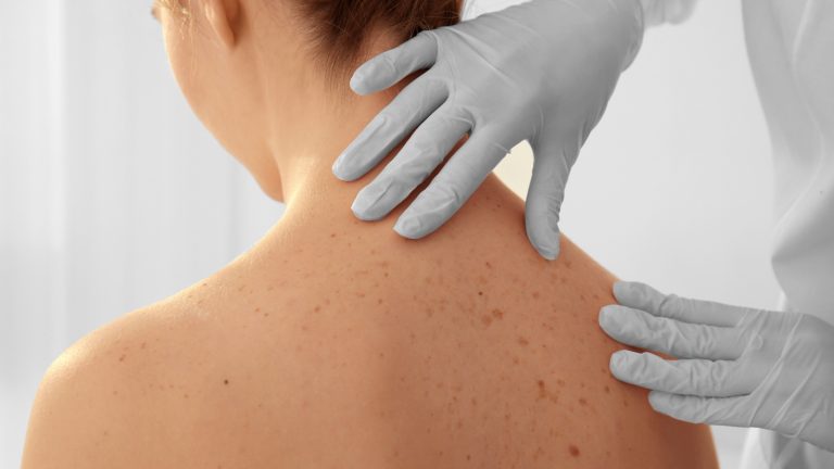 Ultra-personalized therapy for #melanoma israel21c.org/ultra-personal… via @israel21c #SkinCancer #health