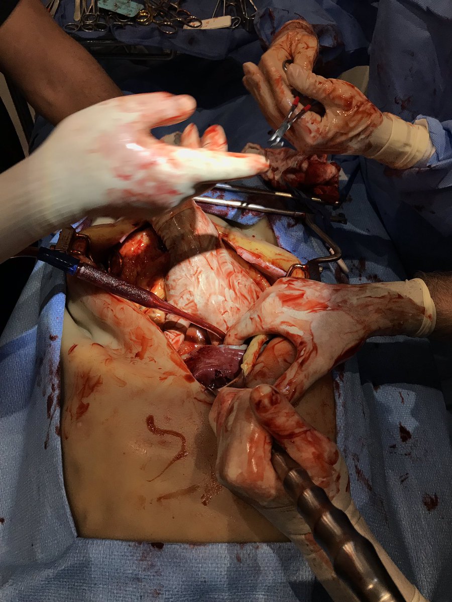 ajlsurg's tweet photo. Simulated splenectomy on an open surgery simulator at #aast2018 #wctc2018 https://t.co/xBudpjpCRf