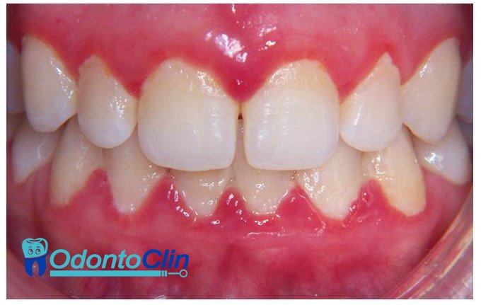 odontoclinCL's tweet photo. ¿Cómo prevenir la gingivitis?: https://t.co/fwsef0Kmaq https://t.co/9at2YGjF7s