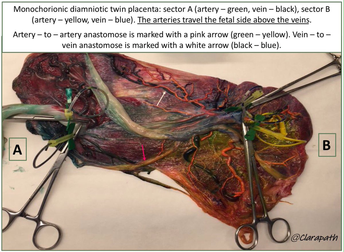 SleepyTwister's tweet photo. Female, 30 years old 🤰🏽. Pregnancy: 30 weeks, monochorionic diamniotic twin placenta 👶🏽👶🏽 . First twin: anhydramnios💧. Second twin: polyhydramnios 💦. Twin-to-twin transfusion syndrome. @clarapath @eugegarfer. #PathArt #PathResidents #PlacentPath https://t.co/Ld5rzTiqng