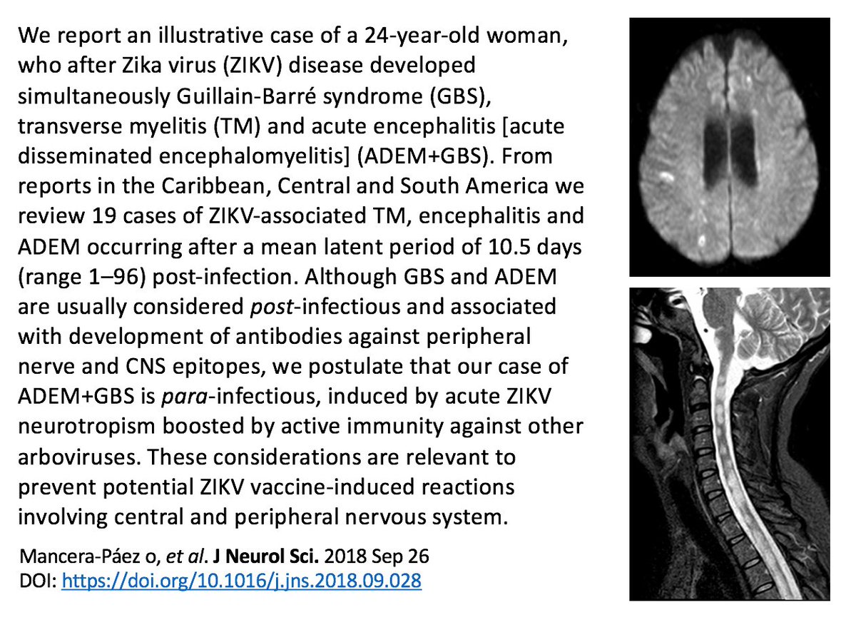 JuanMAnayaC's tweet photo. Concurrent #Guillainbarré syndrome, #transversemyelitis and #encephalitis Post-zika #Zikavirus https://t.co/YQ8gBRbnL6 https://t.co/bwxh3PbRNc