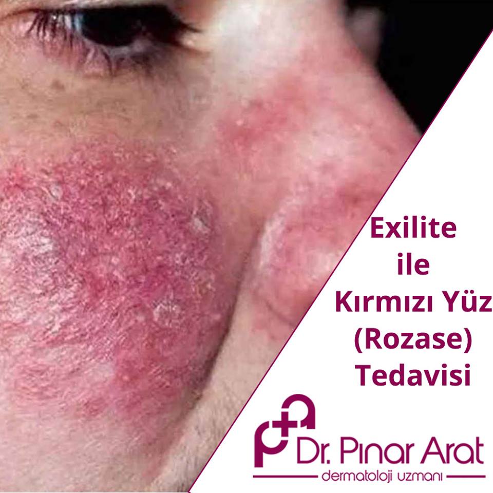 Gül Hastalığı Nasıl Geçer Gül Hastalığı Nasıl Geçer