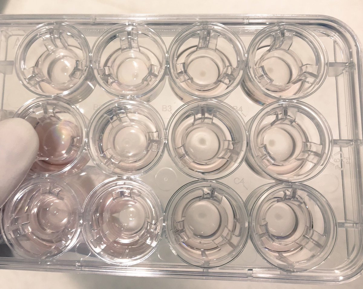 JessicaL_Davis's tweet photo. Latest batch of successful mini-kidneys to study diabetic kidney disease. This will bring us to our 200th organoid generated from human induced pluripotent stem cells. This is why I love my job #IrishResearch #KidneyOrganoids #UCDPhD @UCDDCRC @IrishResearch https://t.co/gAdxb7vMt7